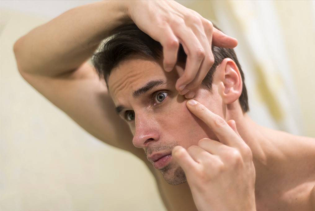 Tackling Acne: Effective Strategies and Products for Adult Men